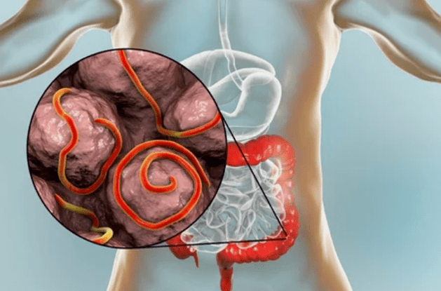 Parasites dans le corps